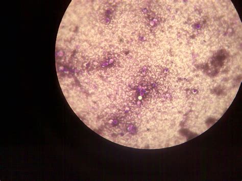 Neoformans var grubii, formerly type a; Cryptococcus neoformans | Medik Bloglist