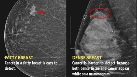 Pei Women Can Expect Breast Density Notification This Fall
