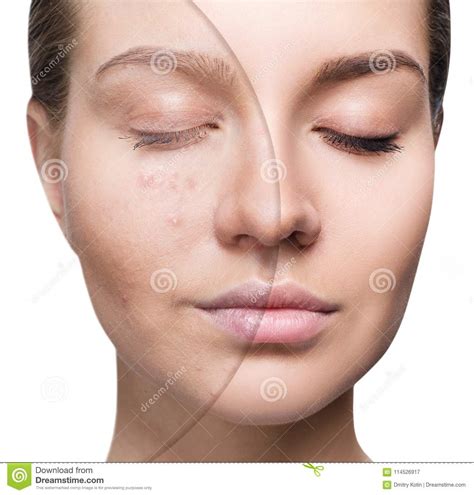 Woman With Acne Before And After Treatment And Make Up Stock Image