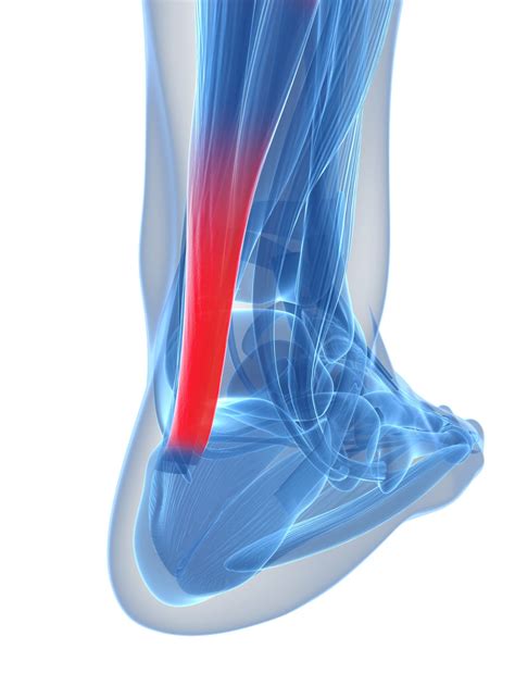 Normal Function Of Tendons Versus Abnormalities