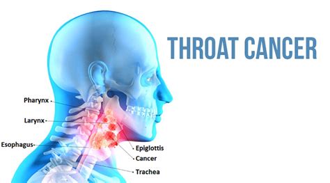 Throat Cancer Causes And Treatments