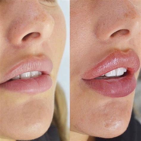 Увеличение губ Cirugias de nariz Tipo de labios Relleno de labios