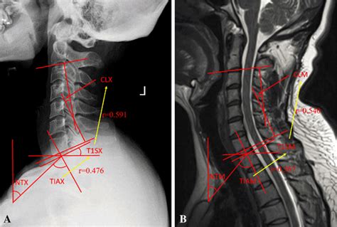 Measurements Of Cervical Sagittal Parameters On X Ray A And Mr B