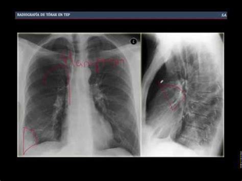 Tromboembolismo Pulmonar YouTube