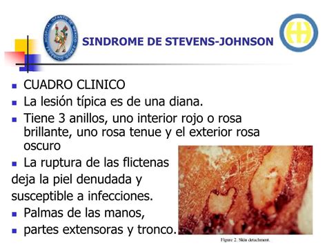 Ppt Sindrome De Stevens Johnson Powerpoint Presentation Free