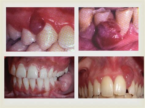 Tumor Of Oral Cavity