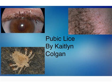 Pubic Lice By Kaitlyn Colgan On Flowvella Presentation Software For