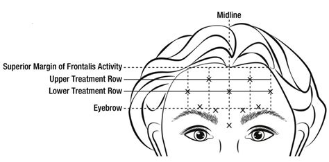 Botox Cosmetic Dosage Guide