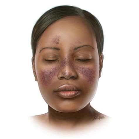 How To Navigate The Signs Of Lupus In The Black Community