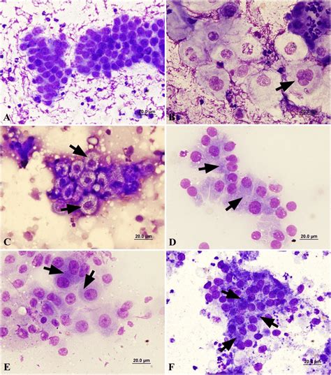 A Aspirate From A Basal Cell Tumor Case N O 14 Cells With A Small