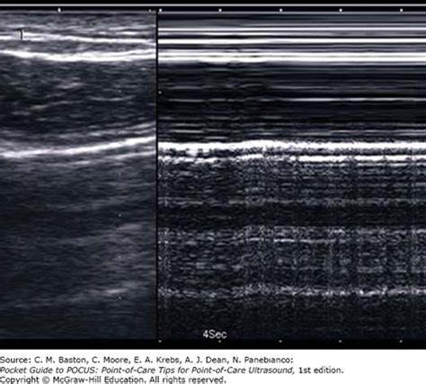 We did not find results for: Lung Ultrasound: Parenchyma and Lung Sliding | Pocket ...