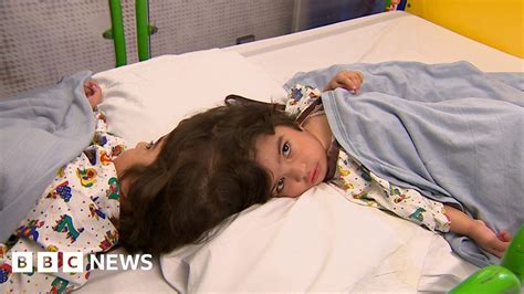 Conjoined Twins How Doctors Separated Twins Joined At The Head Bbc News