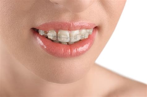 Reasons To Consider Clear Braces Braces By Abbadent Dubuque Ia