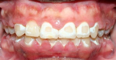 Here are some handy tips for teeth with braces which would try to give you a solution to the question of how to get rid of yellow teeth with braces. Brushing With Braces