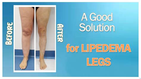 Lipedema Solution Liposuction Surgery Cankles And Knees Immediate