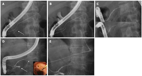 Endoscopic Approach Through The Minor Papilla For The Management Of