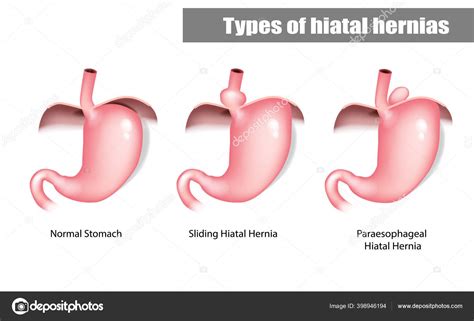 Hiatal Hiatal Hernia And Normal Anatomy Of The Stomach Stock Vector By Annakek