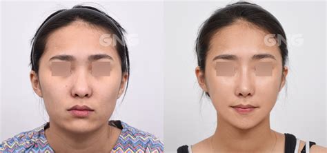 Gng Plastic Surgery Hospital What Is V Line Square Jaw Surgery Gng