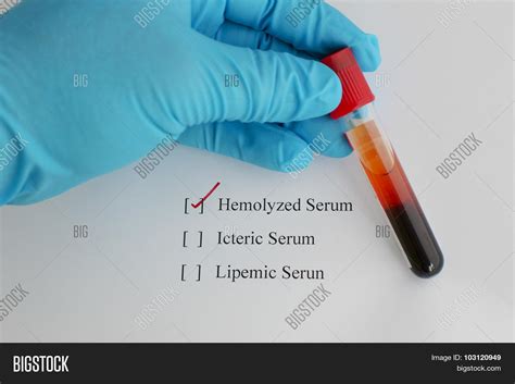 Hemolysis Blood Sample Image And Photo Free Trial Bigstock