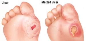 Cat's teeth are covered with bacteria, so when a bite. Non Healing Wounds - Podiatry HQ Clinics