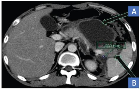 Contrast Enhanced Ct Of The Abdomen Axial Scan At The Level Of T12