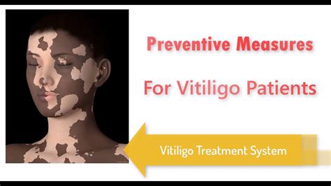 Preventive Measures For Vitiligo Patients Youtube