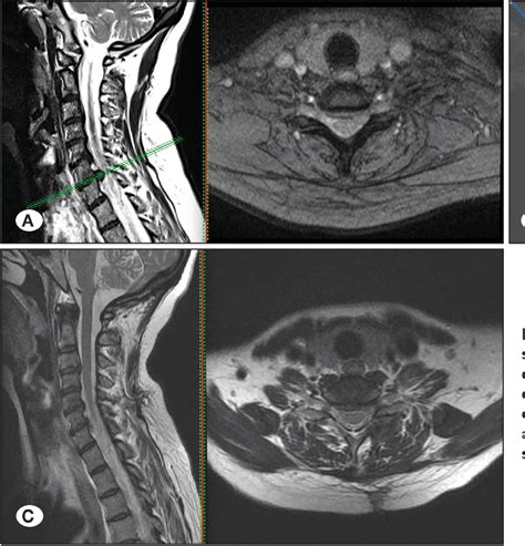 Figure From Posterior Cervical Discectomy Via Keyhole Foraminotomy A Case Series Comparing