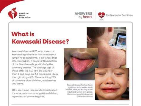 Kawasaki Disease Complications And Treatment American Heart Association