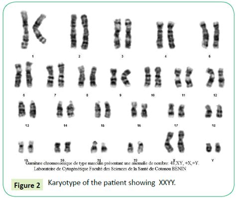 Genetic Disorders Karyotype Patient