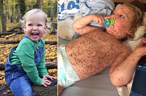 Toddler With ‘worst Case Of Chickenpox ‘turned Away From Doctors