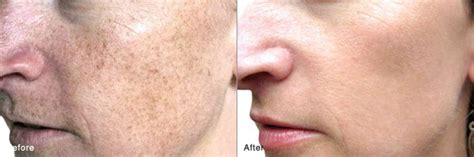 Spots Are Removed To Reveal Smooth Clear And Radiant Skin Age Spot