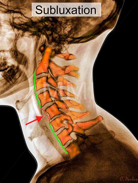 Chiropractic Color X Ray Image Cervical Spine Subluxation Subluxation