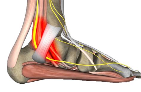 Etf Clinical Case Tarsal Tunnel Syndrome Obrien Medical