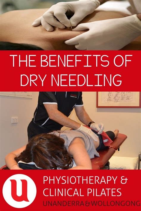 Dry Needling Also Known As Intramuscular Stimulation Ims Or Myofascial Trigger Point Dry