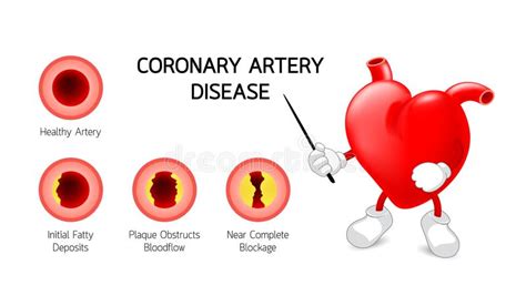 Heart Character With Coronary Artery Disease Info Graphic