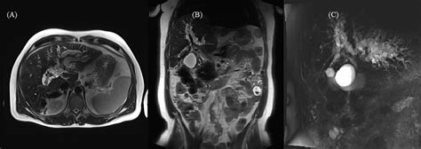 Cureus Peribiliary Cysts Mimicking Primary Sclerosing Cholangitis And