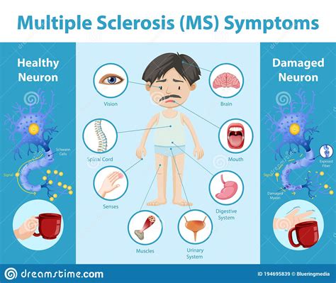 Multiple Sclerosis Ms Symptoms Information Infographic Stock Vector