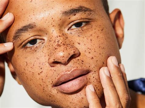 How To Tell If You Have A Mole Birthmark Or Freckle