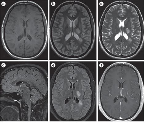 Standardized Brain Mri Protocol To Evaluate Patients In Whom Multiple