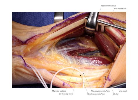 Anterior Interosseous To Ulnar Motor Nerve Transfer Surgical
