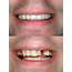 Why It Is Important To Replace Missing Teeth  Smile Essentials