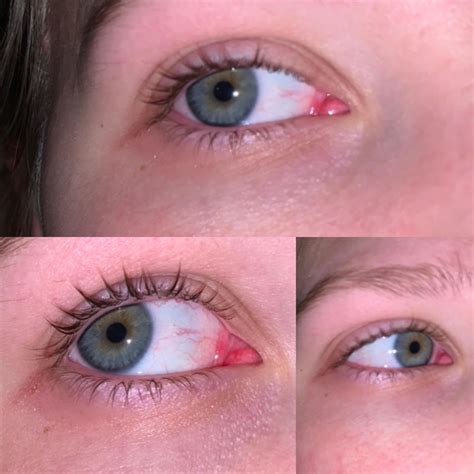 Constantly Dripping And Leaking Eye Irritated And Raw On The Outer