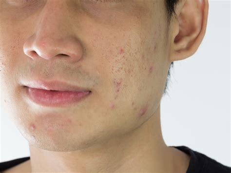 Skin Bumps That Look Like Pimples But Arent
