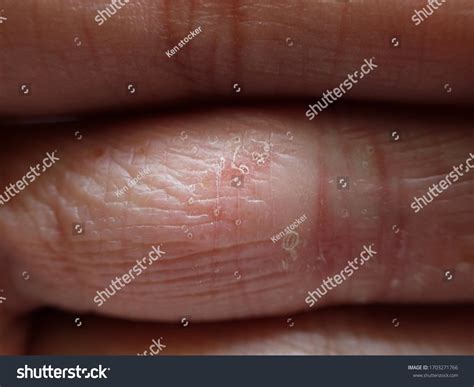 103 Pompholyx Eczema 이미지 스톡 사진 및 벡터 Shutterstock