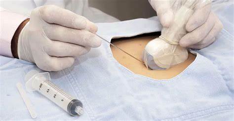 Онемение живота после кесарева сечения как убрать