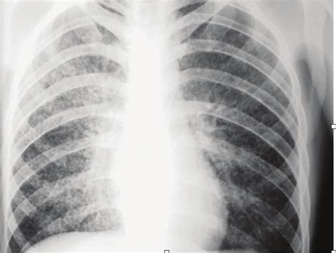 Chest Radiograph Showing Diffuse Micro Nodular Infiltrates In Both Lung