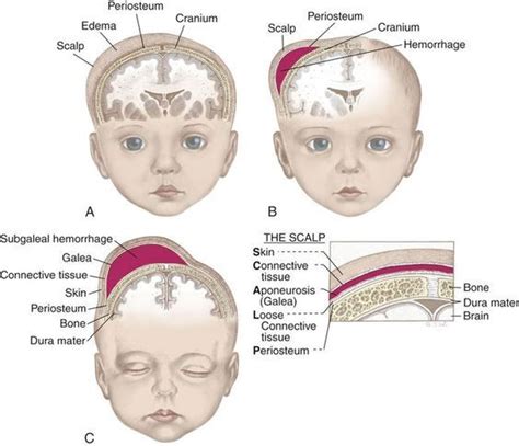 Differences Between Caput Succedaneum Cephalhematoma And Subgaleal