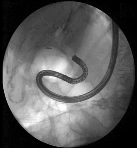 Fluoroscopic Appearance Of Direct Peroral Cholangioscopy With The Tip