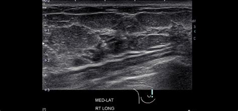 The exact cause of breast. Good News for Children During Breast Cancer Awareness ...