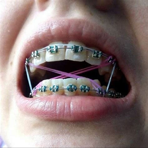 Pin De Shrood Burgos En Braces Ortodoncia Brackets Fondo De